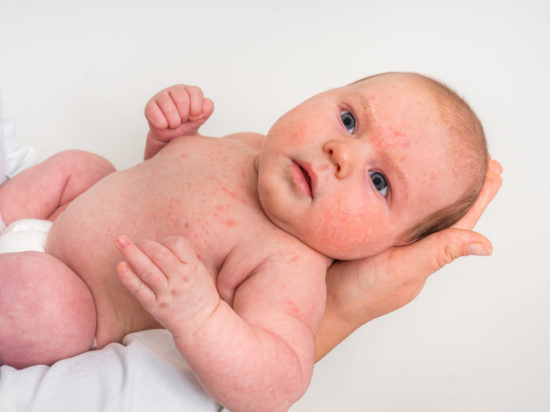An infant with a skin rash