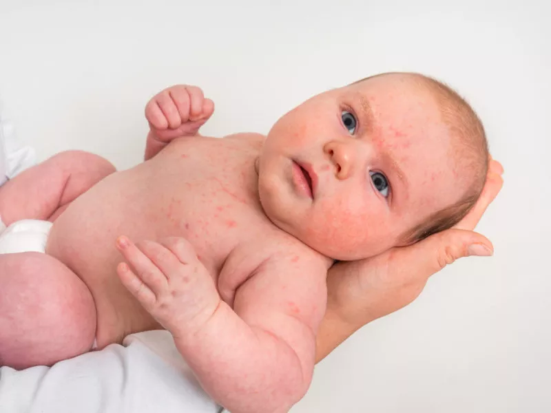 An infant with a skin rash, atopowe zapalenie skóry