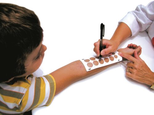 dziecko, punktowy test skórny, testy na alergię